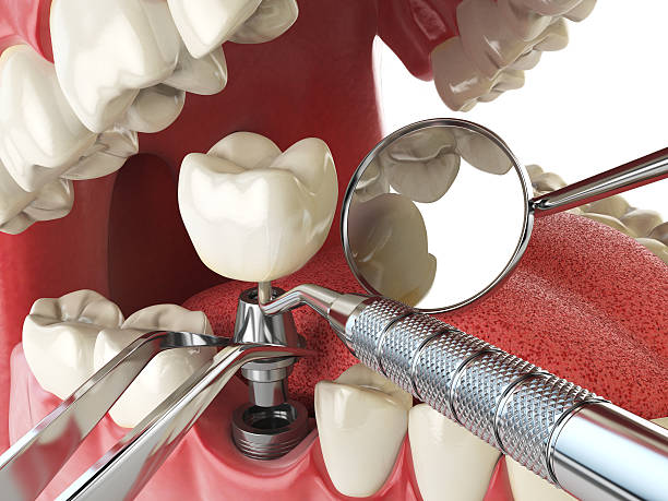 Best Emergency Treatment for Dental Infections or Abscesses in Pleasant View, UT