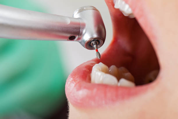Best Emergency Dental Care for Broken or Chipped Teeth in Pleasant View, UT